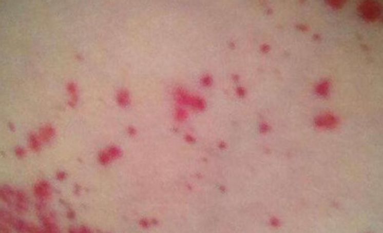 3、白血病初期小红点图片:白血病早期症状
