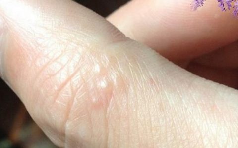 手指出现小水泡是大病前兆