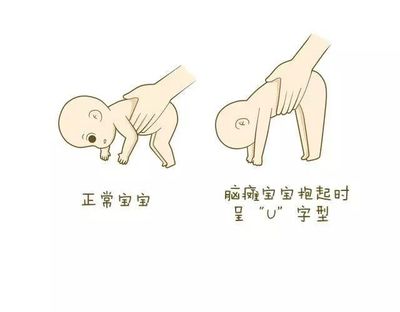 正常婴儿与脑瘫婴儿拇指握拳差别
