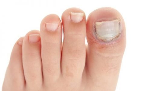 灰指甲最简便的方法擦什么药膏 灰指押是一种常见的真菌感染指甲恶疾