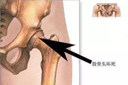 骨股头坏死最明显的疼痛位置