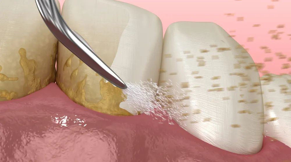 牙膏上放盐刷牙真的美白吗 张开嘴就能看到一口洁白的牙齿