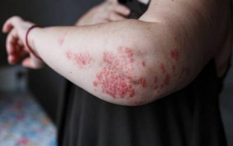 过敏皮炎一般几天可以恢复 每个人皮肤过敏反应程度不一样